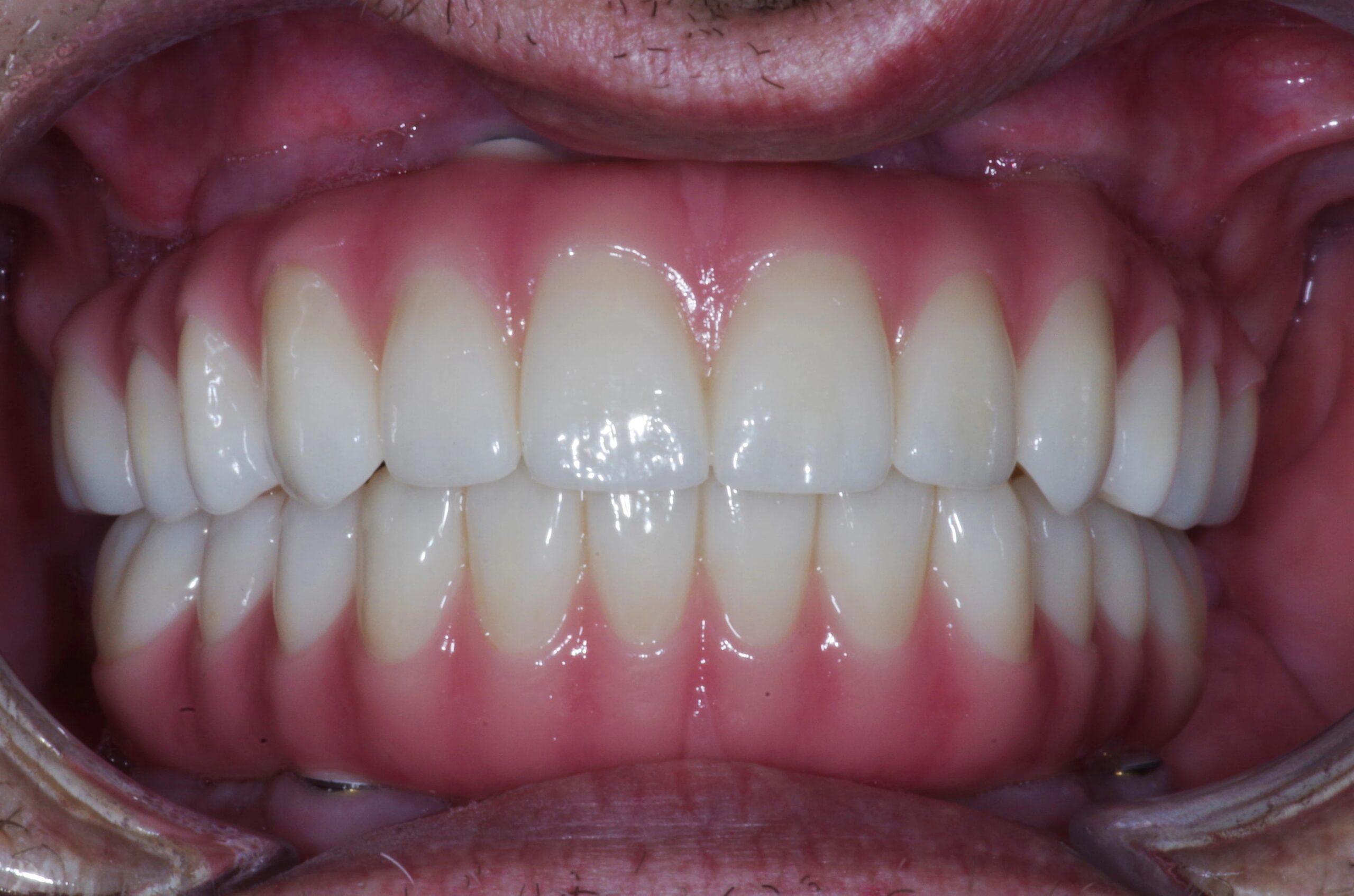 Permanent Fixed Full Arch — All-on-X