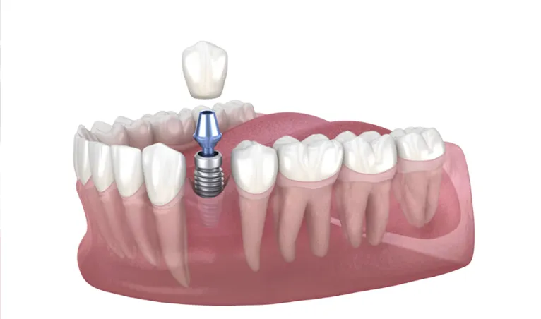 Single Dental Implant