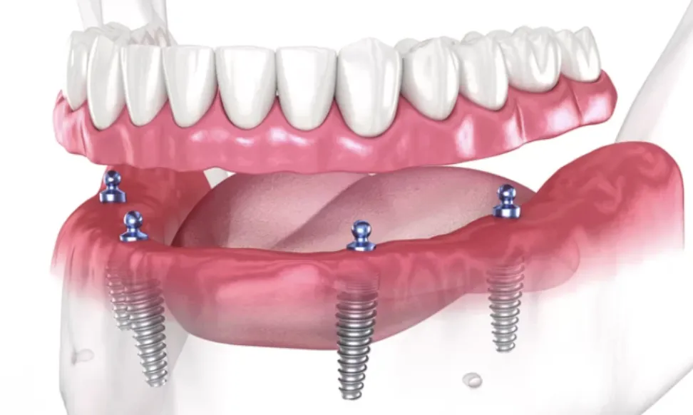 Snap-On Implant Denture